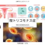 膣トリコモナス症（Trichomoniasis） – 感染症