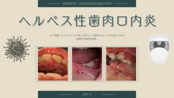 ヘルペス性歯肉口内炎（Herpetic Gingivostomatitis） – 感染症