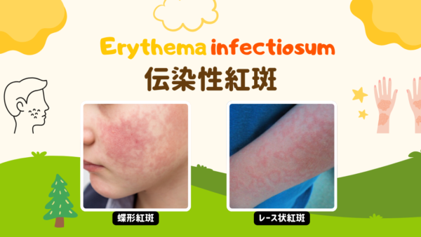 伝染性紅斑（リンゴ病）（Erythema infectiosum） – 感染症