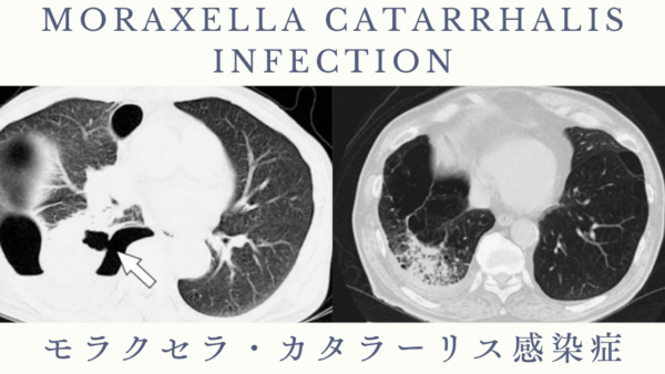 モラクセラ・カタラーリス感染症（Moraxella catarrhalis infection） – 感染症