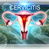 子宮頸管炎（Cervicitis） – 感染症