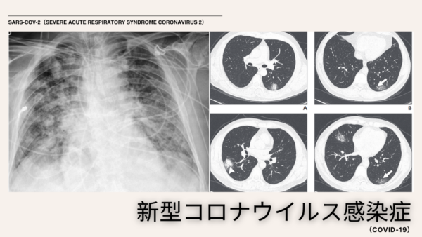 新型コロナウイルス感染症（COVID-19）