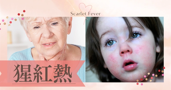 猩紅熱（Scarlet Fever） – 感染症
