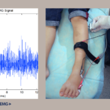 筋電図検査（筋電図 / Electromyography / EMG）