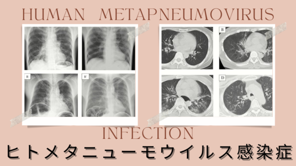 ヒトメタニューモウイルス感染症（human metapneumovirus infection） － 感染症疾患